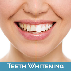 Teeth Whitening