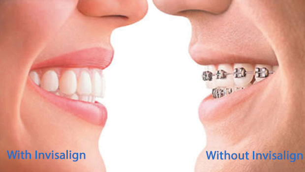 Invisalign